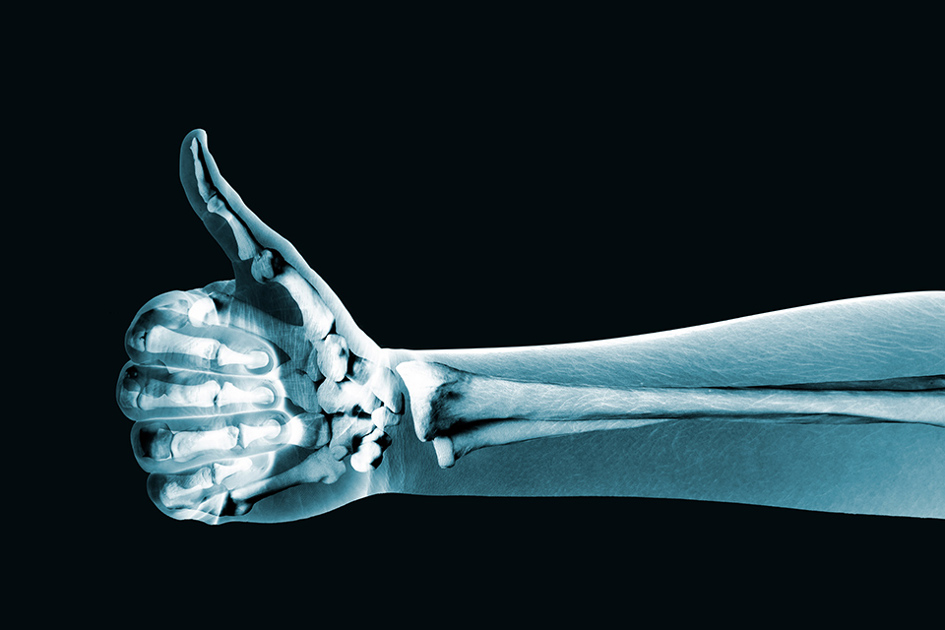 Röntgen Hand Tummen Upp
